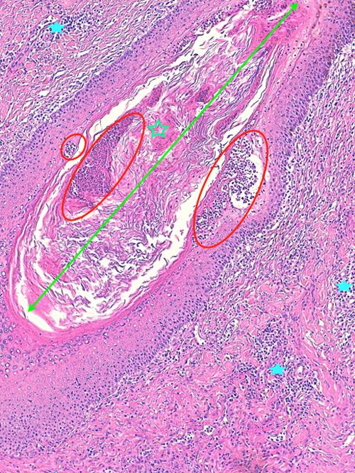 Un cas de pododermatite à ankylostomatidés chez un chien