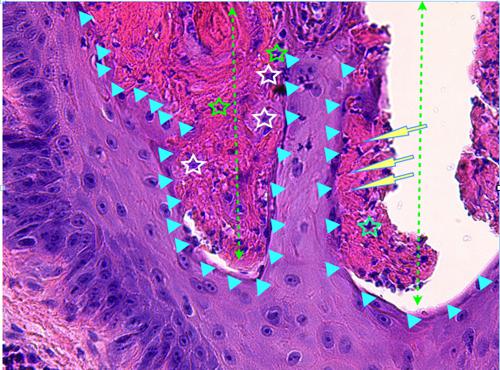 Un cas de pododermatite à ankylostomatidés chez un chien