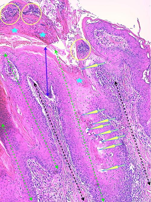 Un cas de pododermatite à ankylostomatidés chez un chien