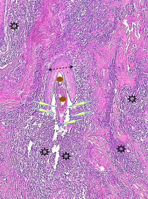 Un cas de pododermatite à ankylostomatidés chez un chien