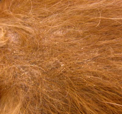 cas-dadenite-sebacee-granulomateuse10
