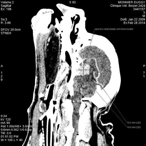 cas-de-calcinose-cutanee-majeure-secondaire-a-macroadenome-hypophysaire9