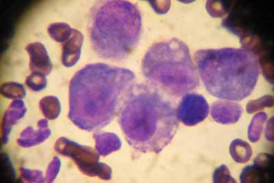 cas-de-carcinomatose-mammaire8
