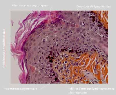 cas-de-dermatite-exfoliative-paraneoplasique-associee-a-thymome6