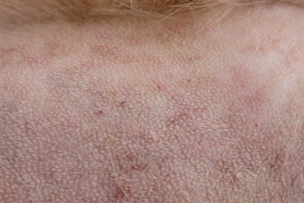 cas-de-dermatite-pyotraumatique-due-a-gale-sarcoptique10