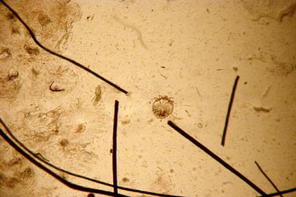cas-de-dermatite-pyotraumatique-due-a-gale-sarcoptique11