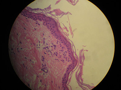 cas-de-dermatomyosite12