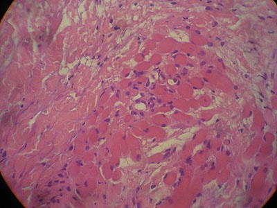 cas-de-dermatomyosite13