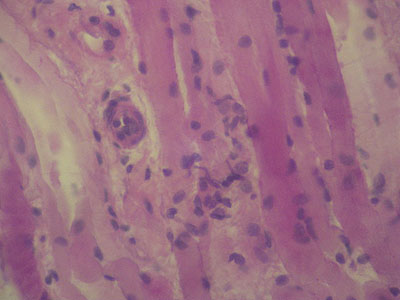 cas-de-dermatomyosite14
