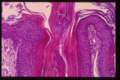 cas-de-dermatose-ichtyosiforme-chez-un-jeune-berger-allemand10