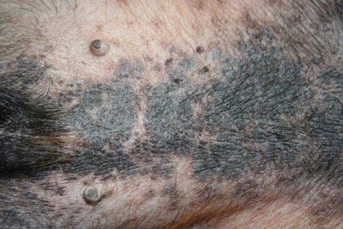 cas-de-dermite-lichenoide-psoriasiforme1
