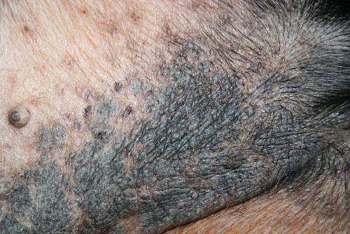 cas-de-dermite-lichenoide-psoriasiforme2