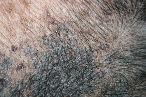 cas-de-dermite-lichenoide-psoriasiforme3