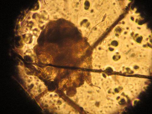 Un cas de gale sarcoptique associé à une vascularite neutrophilique cas-de-gale-sarcoptique-associe-a-vascularite-neutrophilique12