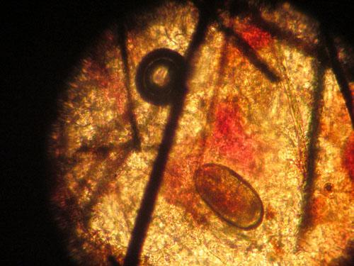 Un cas de gale sarcoptique associé à une vascularite neutrophilique cas-de-gale-sarcoptique-associe-a-vascularite-neutrophilique13