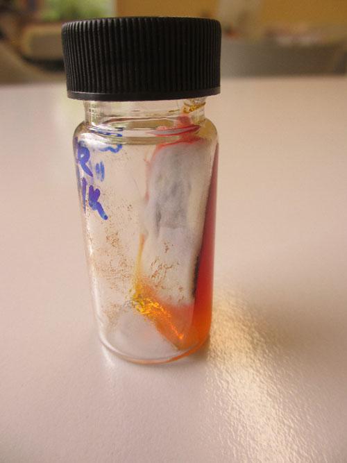 Un cas de gale sarcoptique associé à une vascularite neutrophilique cas-de-gale-sarcoptique-associe-a-vascularite-neutrophilique14