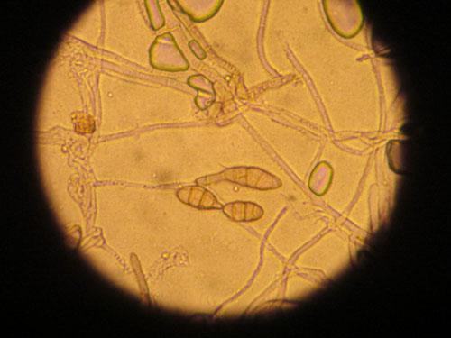 Un cas de gale sarcoptique associé à une vascularite neutrophilique cas-de-gale-sarcoptique-associe-a-vascularite-neutrophilique15