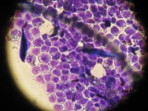 cas-de-lymphome-cutane-epitheliotrope12