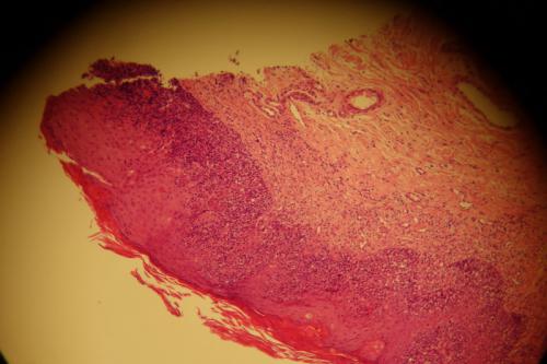 cas-de-lymphome-cutane-epitheliotrope13