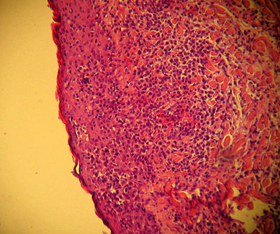 cas-de-mycosis-fongoide-chez-chien14