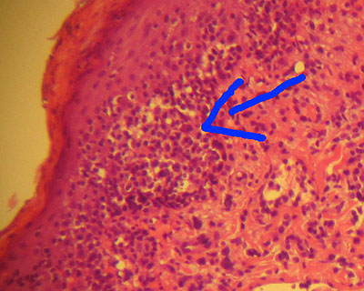 cas-de-mycosis-fongoide-chez-chien15