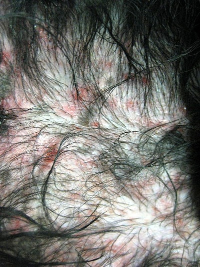 cas-de-mycosis-fongoide-chez-chien4