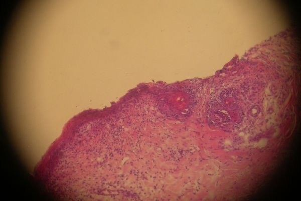 cas-de-mycosis-fongoide-chez-une-chienne-histo1