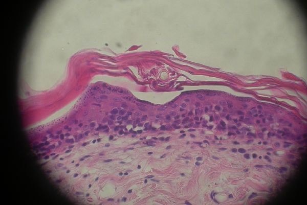 cas-de-mycosis-fongoide-chez-une-chienne-histo2