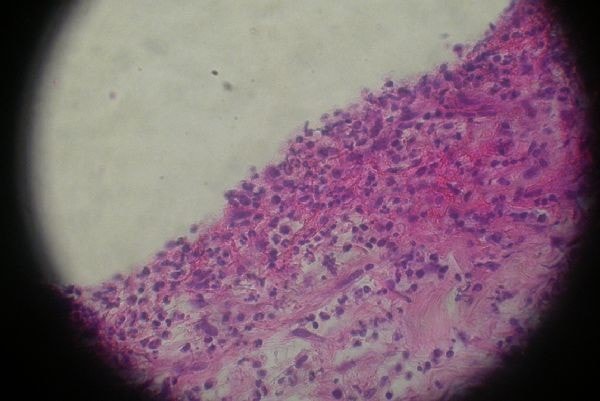 cas-de-mycosis-fongoide-chez-une-chienne-histo3