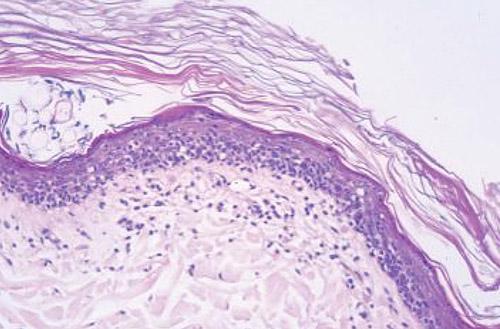 cas-de-mycosis-fongoide4-histo