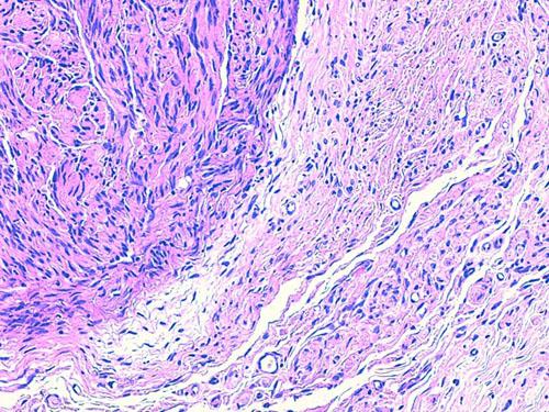 Un cas de neurofibromatose chez une chienne Shetland