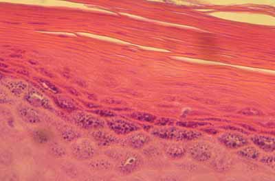 cas-de-parakeratose-granulaire10