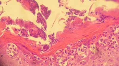 cas-de-parakeratose-granulaire11