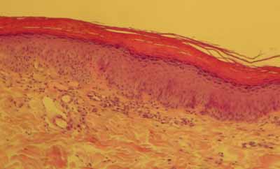 cas-de-parakeratose-granulaire9