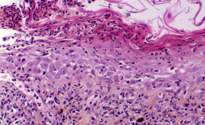 Un cas de pemphigus érythémateux canin