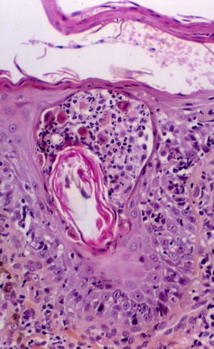 Un cas de pemphigus érythémateux canin