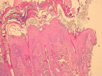 Un cas de pemphigus foliacé chez une chatte