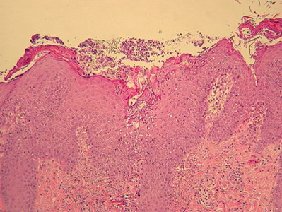 Un cas de pemphigus foliacé chez une chatte