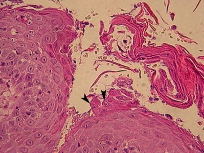 Un cas de pemphigus foliacé chez une chatte