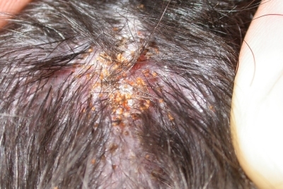 Dermatoses parasitaires