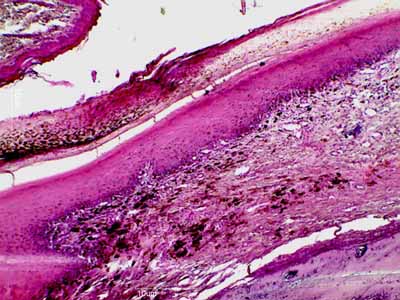 Un cas d'onychodystrophie lupoide symétrique d'un Caniche