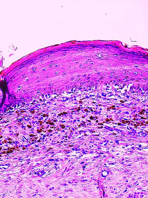 cas-donychodystrophie-lupoide-symetrique6