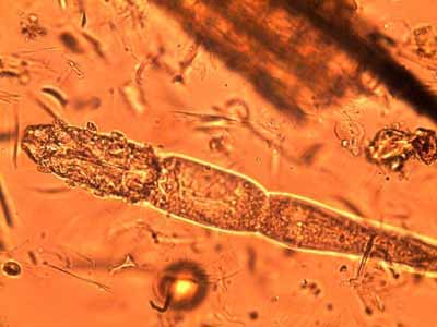 Dermatoses parasitaires