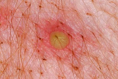 Actualités sur la démodécie demodecie3