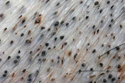 Actualités sur la démodécie demodecie4