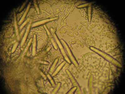 dermatomycose-encolure13