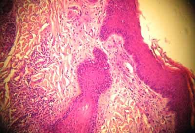 dermatomycose-encolure7