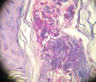 dermatomycose-encolure8