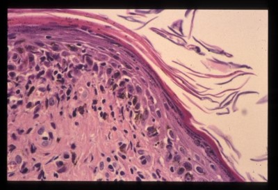 dermatophytose-a-microsporum-persicolor5
