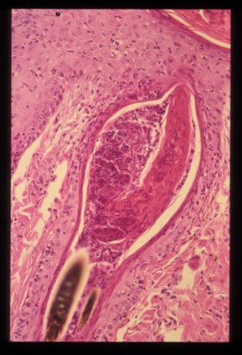 dermatophytose-a-microsporum-persicolor6